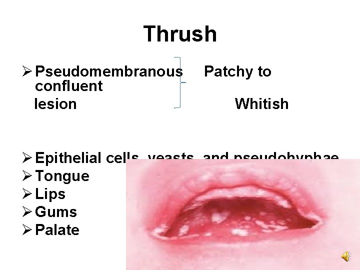 Thrush Ø Pseudomembranous confluent lesion Patchy to Whitish Ø Epithelial cells, yeasts, and pseudohyphae.
