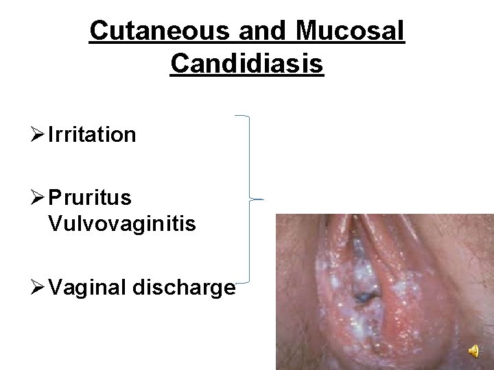 Cutaneous and Mucosal Candidiasis Ø Irritation Ø Pruritus Vulvovaginitis Ø Vaginal discharge 