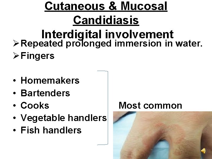 Cutaneous & Mucosal Candidiasis Interdigital involvement Ø Repeated prolonged immersion in water. Ø Fingers