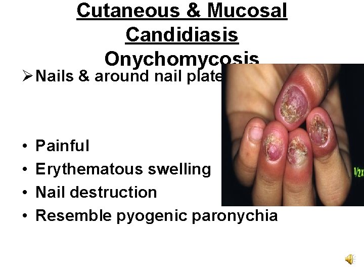 Cutaneous & Mucosal Candidiasis Onychomycosis Ø Nails & around nail plate. • • Painful