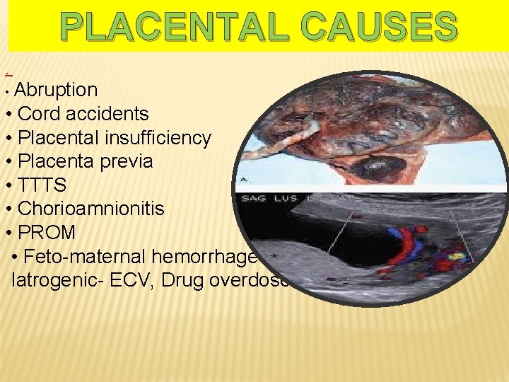 PLACENTAL CAUSES. • Abruption • Cord accidents • Placental insufficiency • Placenta previa •