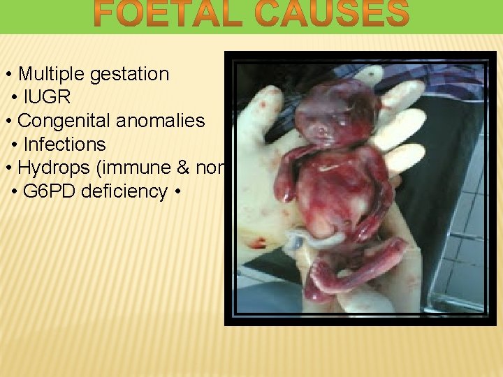  • Multiple gestation • IUGR • Congenital anomalies • Infections • Hydrops (immune