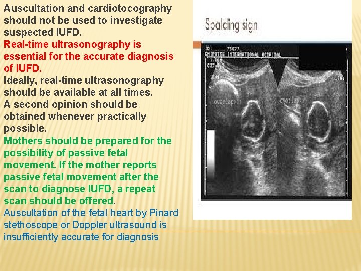 Auscultation and cardiotocography should not be used to investigate suspected IUFD. Real-time ultrasonography is