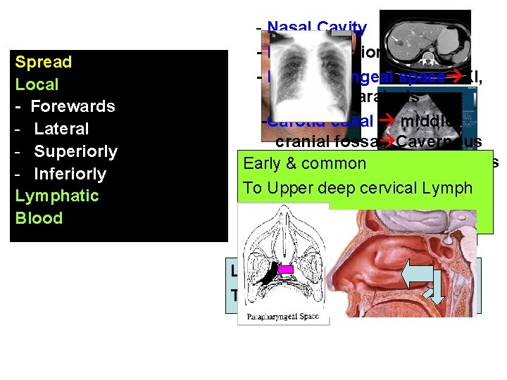 Spread Local - Forewards - Lateral - Superiorly - Inferiorly Lymphatic Blood - Nasal