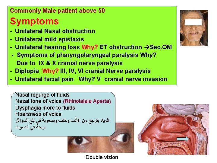 Commonly Male patient above 50 Symptoms - Unilateral Nasal obstruction - Unilateral mild epistaxis