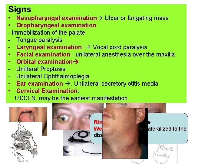 Signs • Nasopharyngal examination Ulcer or fungating mass • Oropharyngeal examination - immobilization of