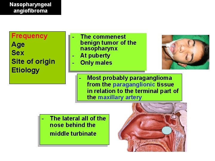 Nasopharyngeal angiofibroma Frequency Age Sex Site of origin Etiology - The commenest benign tumor