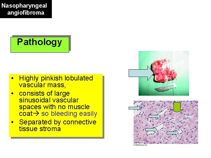 Nasopharyngeal angiofibroma Pathology • Highly pinkish lobulated vascular mass, • consists of large sinusoidal