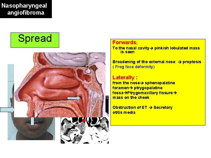 Nasopharyngeal angiofibroma Spread Forwards; To the nasal cavity pinkish lobulated mass is seen Broadening