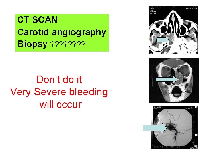 CT SCAN Carotid angiography Biopsy ? ? ? ? Don’t do it Very Severe