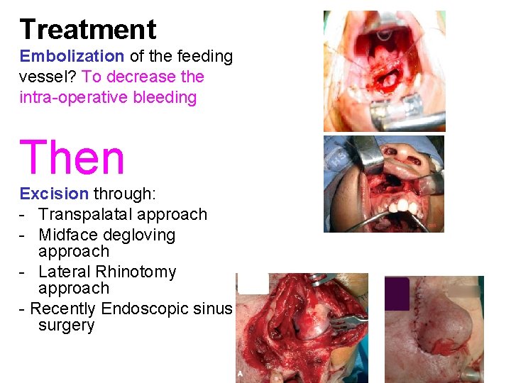 Treatment Embolization of the feeding vessel? To decrease the intra-operative bleeding Then Excision through: