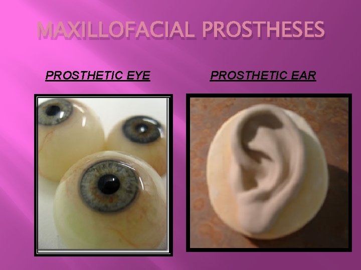 MAXILLOFACIAL PROSTHESES PROSTHETIC EYE PROSTHETIC EAR 