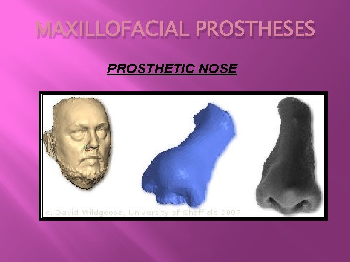 MAXILLOFACIAL PROSTHESES PROSTHETIC NOSE 