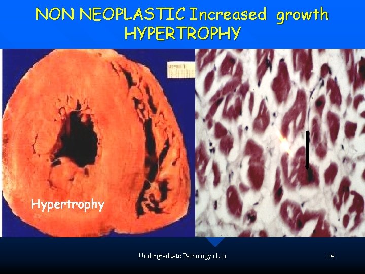 NON NEOPLASTIC Increased growth HYPERTROPHY Hypertrophy Undergraduate Pathology (L 1) 14 