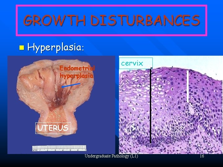 GROWTH DISTURBANCES n Hyperplasia: Endometrial hyperplasia cervix UTERUS Undergraduate Pathology (L 1) 16 