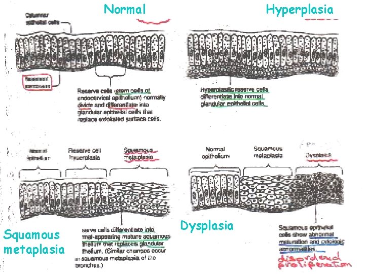 Normal Increased Squamous metaplasia growth Hyperplasia Dysplasia Undergraduate Pathology (L 1) 19 