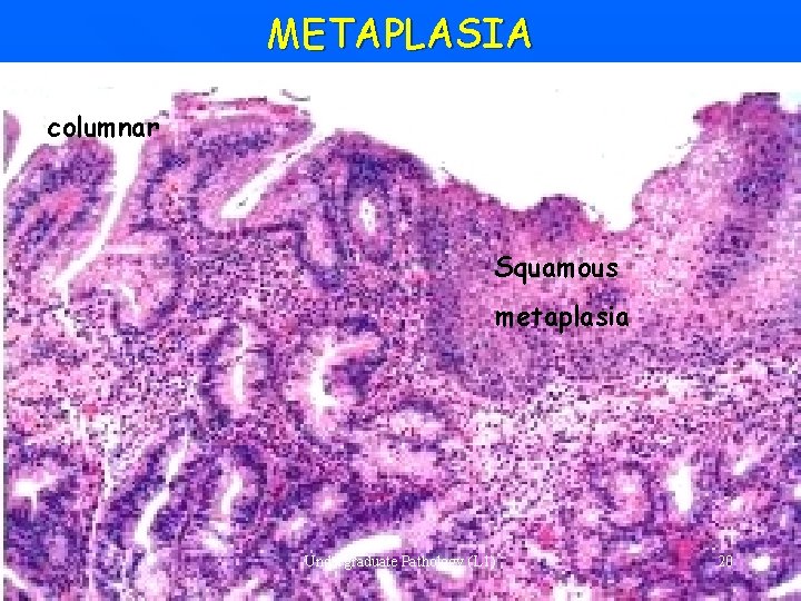 METAPLASIA columnar Squamous metaplasia Undergraduate Pathology (L 1) 20 