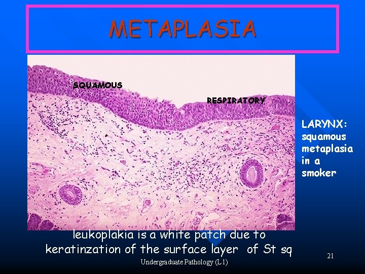 METAPLASIA SQUAMOUS RESPIRATORY LARYNX: squamous metaplasia in a smoker leukoplakia is a white patch