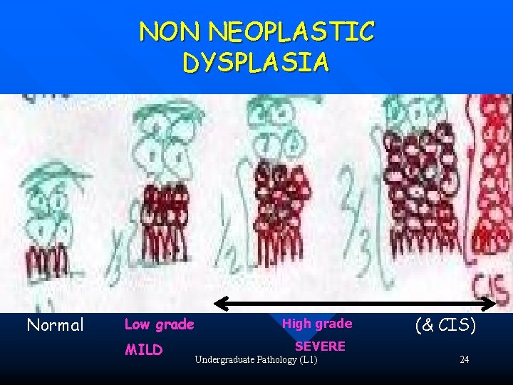 NON NEOPLASTIC DYSPLASIA Normal Low grade MILD High grade (& CIS) SEVERE Undergraduate Pathology