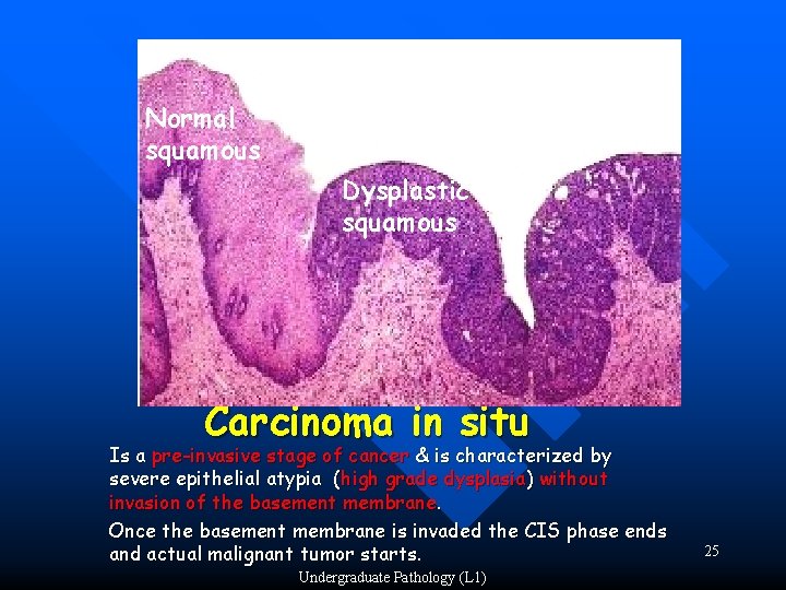 Normal squamous Dysplastic squamous Carcinoma in situ Is a pre-invasive stage of cancer &