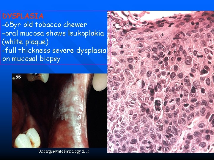 DYSPLASIA -65 yr old tobacco chewer -oral mucosa shows leukoplakia (white plaque) -full thickness