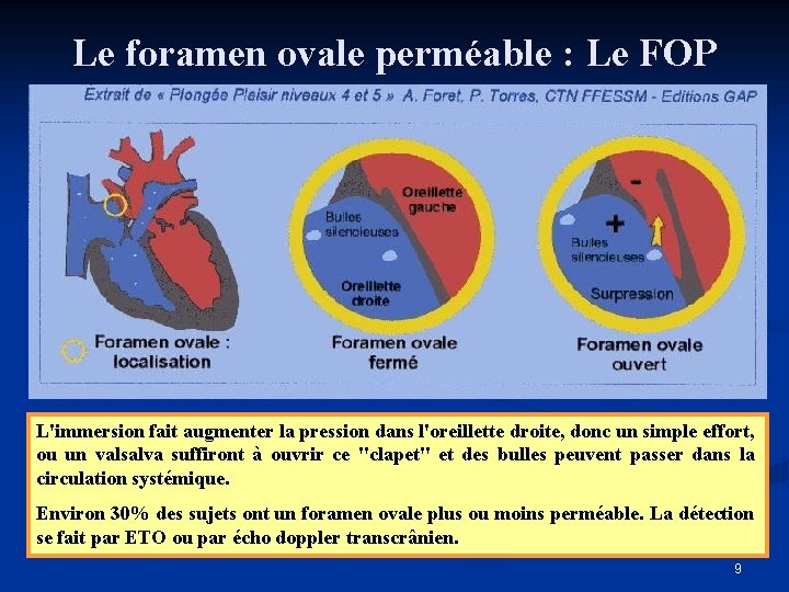 Le foramen ovale perméable : Le FOP L'immersion fait augmenter la pression dans l'oreillette