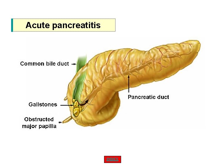 Acute pancreatitis INDEX 