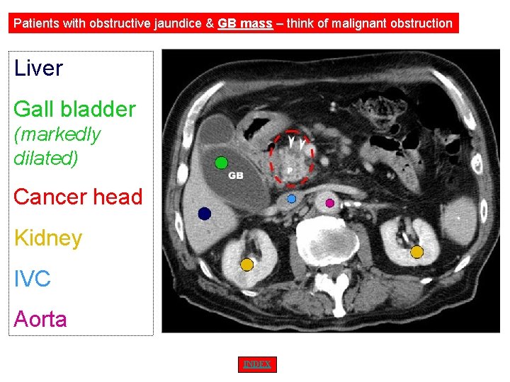 Patients with obstructive jaundice & GB mass – think of malignant obstruction Liver Gall