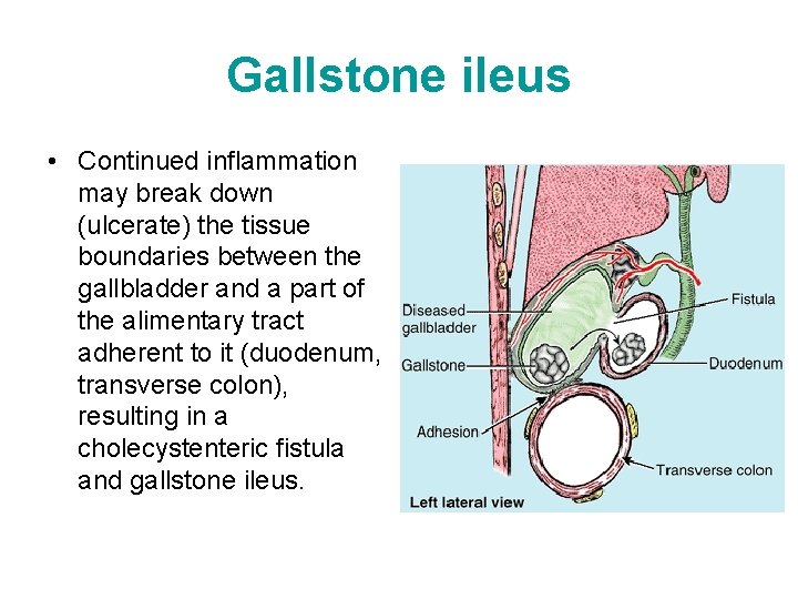 Gallstone ileus • Continued inflammation may break down (ulcerate) the tissue boundaries between the