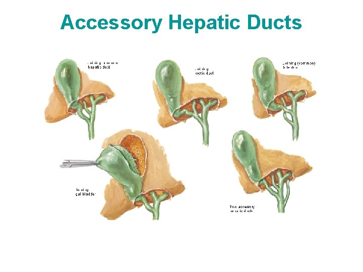 Accessory Hepatic Ducts 