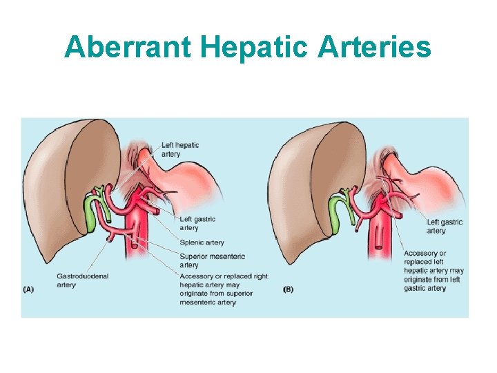 Aberrant Hepatic Arteries 