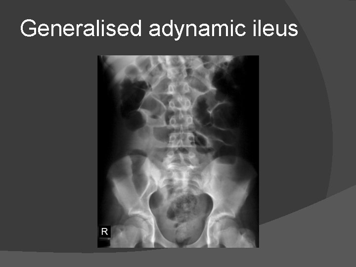 Generalised adynamic ileus 