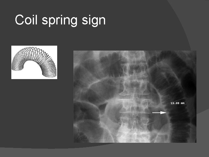 Coil spring sign 