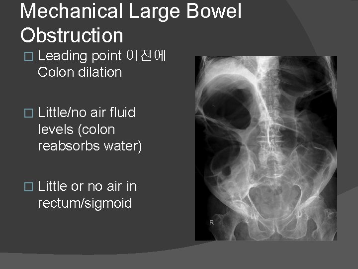 Mechanical Large Bowel Obstruction � Leading point 이전에 Colon dilation � Little/no air fluid