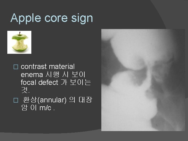 Apple core sign contrast material enema 시행 시 보이 focal defect 가 보이는 것.