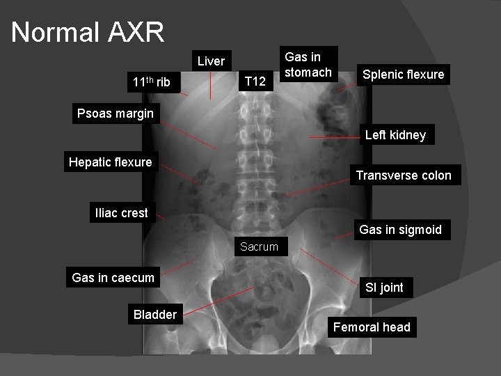 Normal AXR Liver 11 th rib T 12 Gas in stomach Splenic flexure Psoas