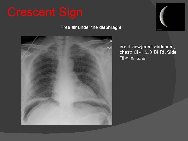 Crescent Sign Free air under the diaphragm erect view(erect abdomen, chest) 에서 보이며 Rt.