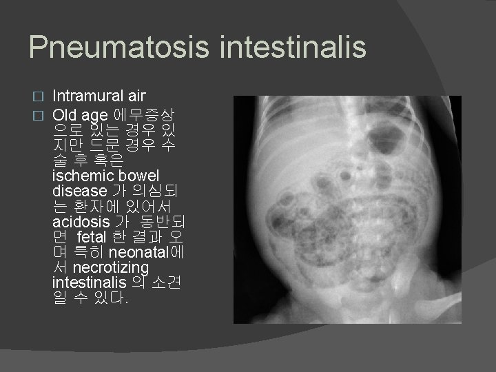 Pneumatosis intestinalis � � Intramural air Old age 에무증상 으로 있는 경우 있 지만