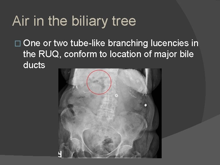 Air in the biliary tree � One or two tube-like branching lucencies in the