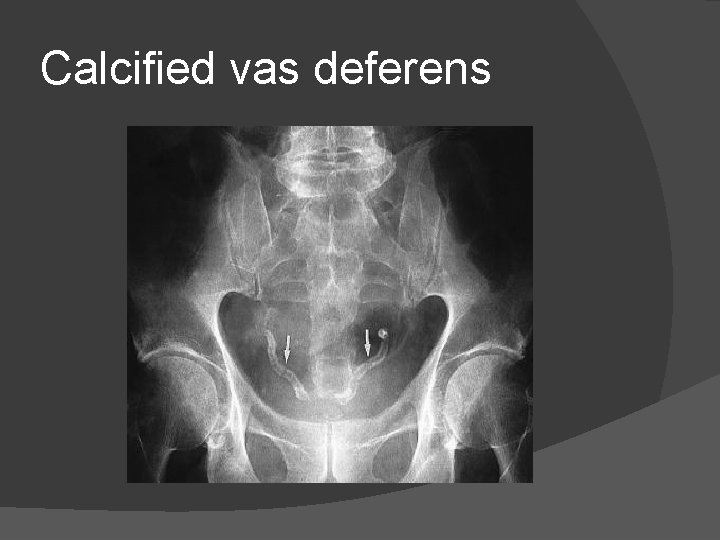 Calcified vas deferens 