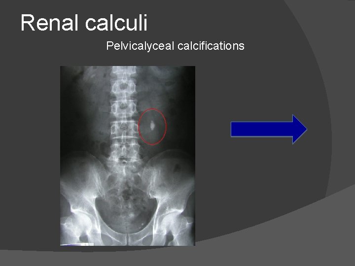 Renal calculi Pelvicalyceal calcifications 