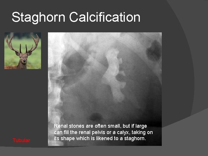 Staghorn Calcification Tubular Renal stones are often small, but if large can fill the