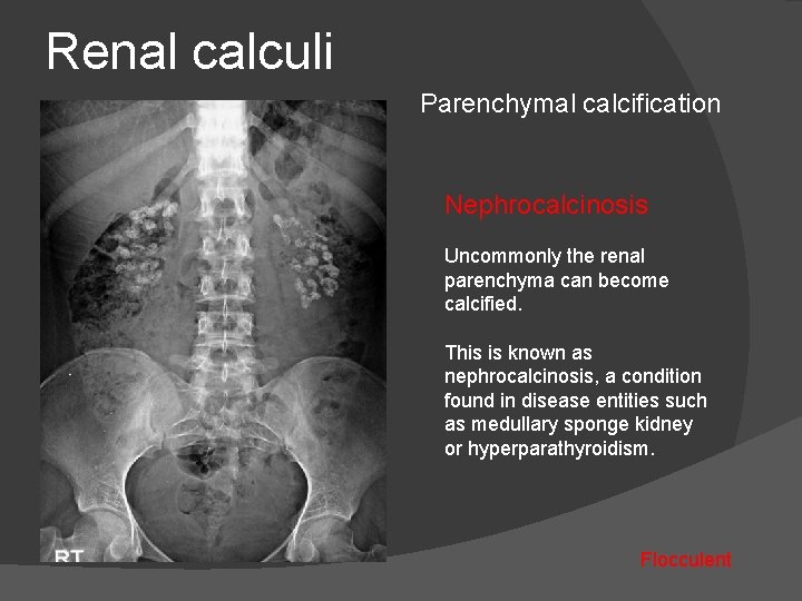 Renal calculi Parenchymal calcification Nephrocalcinosis Uncommonly the renal parenchyma can become calcified. This is