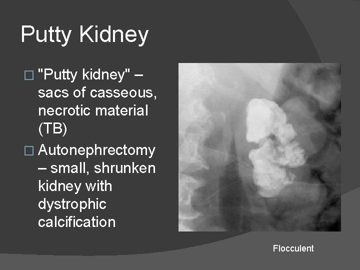 Putty Kidney � "Putty kidney" – sacs of casseous, necrotic material (TB) � Autonephrectomy