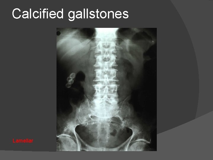Calcified gallstones Lamellar 