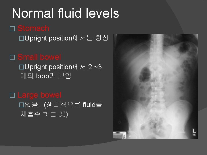 Normal fluid levels � Stomach �Upright position에서는 항상 � Small bowel �Upright position에서 2