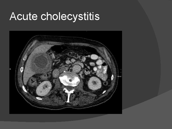 Acute cholecystitis 