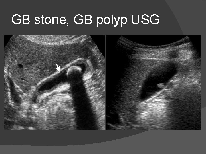 GB stone, GB polyp USG 