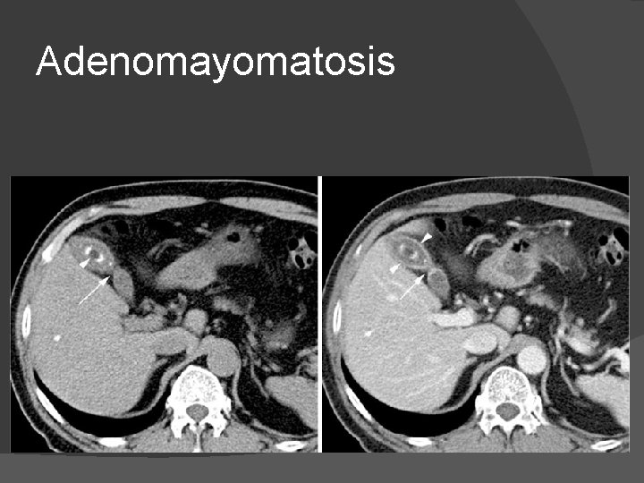 Adenomayomatosis 