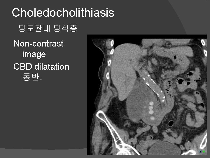 Choledocholithiasis 담도관내 담석증 Non-contrast image CBD dilatation 동반. 
